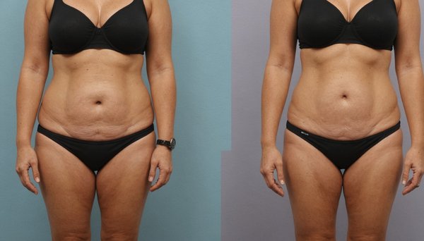 Liposuccion à marseille : embellissez votre silhouette en douceur